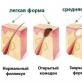 Как лечить акне, профилактика